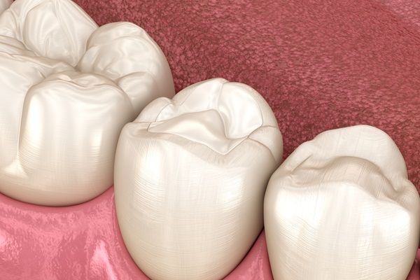 Prevent Further Tooth Decay With Dental Fillings